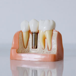 Dental Implants: An Integral Part of Cosmetic Dentistry