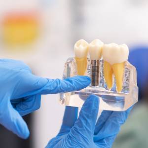 Aftercare Tips for Recovery from Dental Implants in Edison