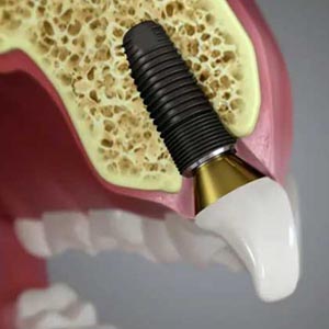 Facts You Should Know About Dental Implants in Kendall Park