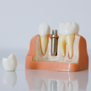 The Step-by-Step Guide to Getting Dental Implants in Edison