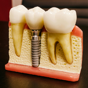 Why Dental Implants in Edison Are Better for Tooth Loss